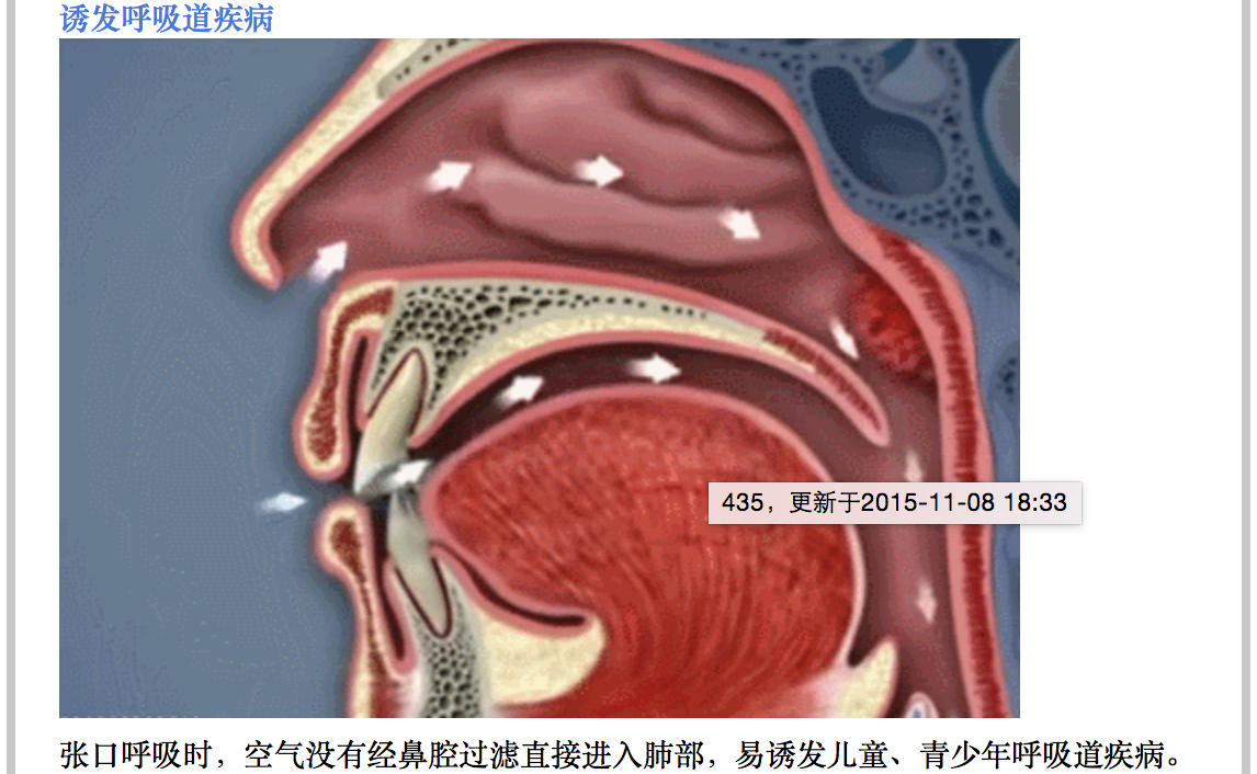 小孩有张口呼吸，家长得警惕！