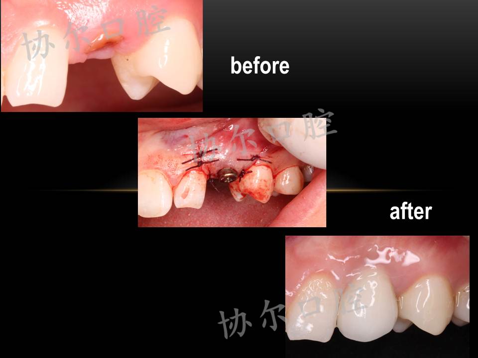 前牙美学种植修复
