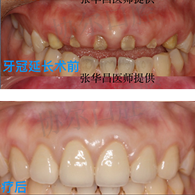 牙冠延长术