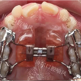 牙弓狭窄、腭部高拱，隐藏的儿童牙颌面部发育异常