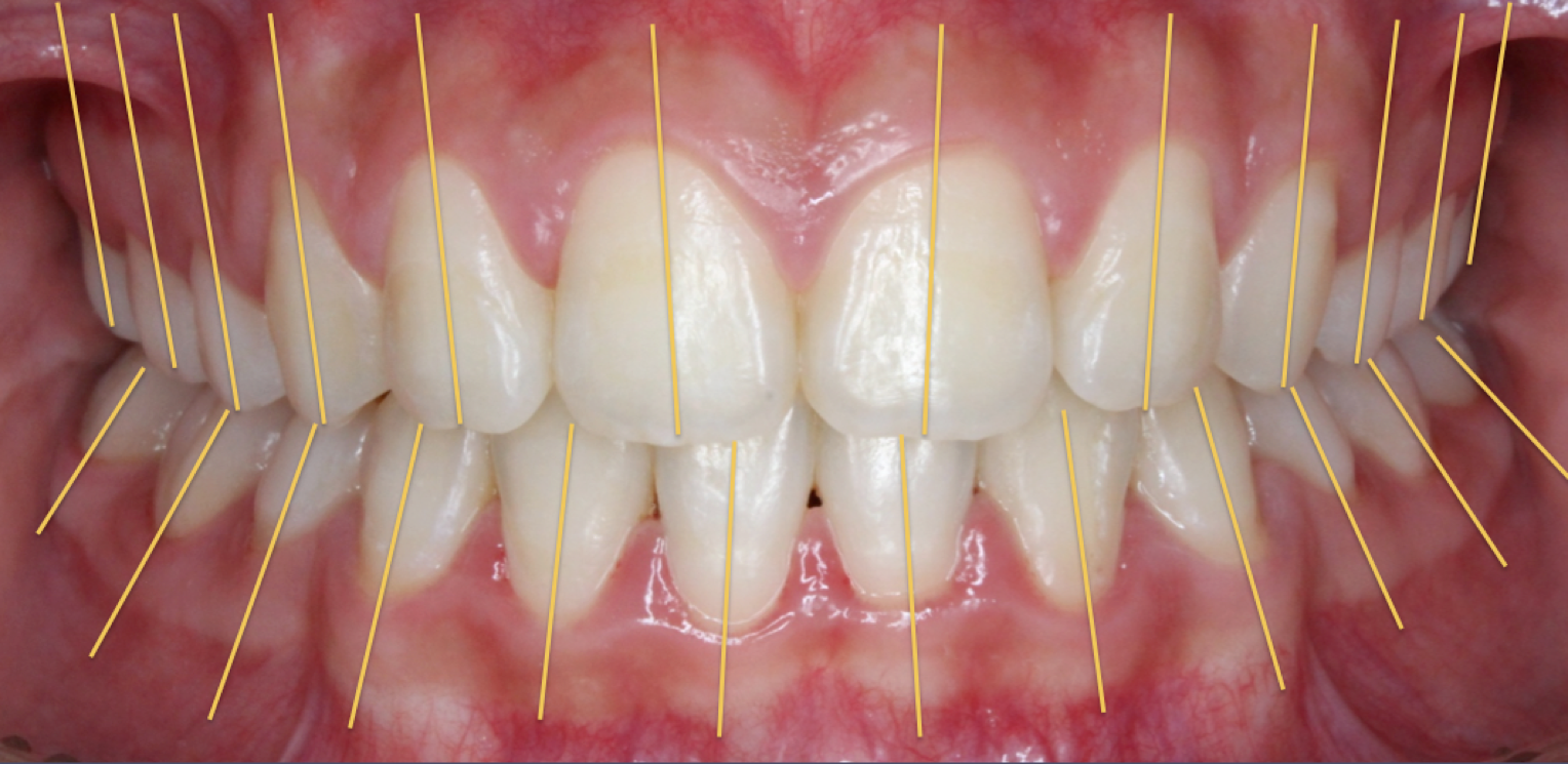 1 首先,牙齿的静态排列需要符合三维方向的标准.