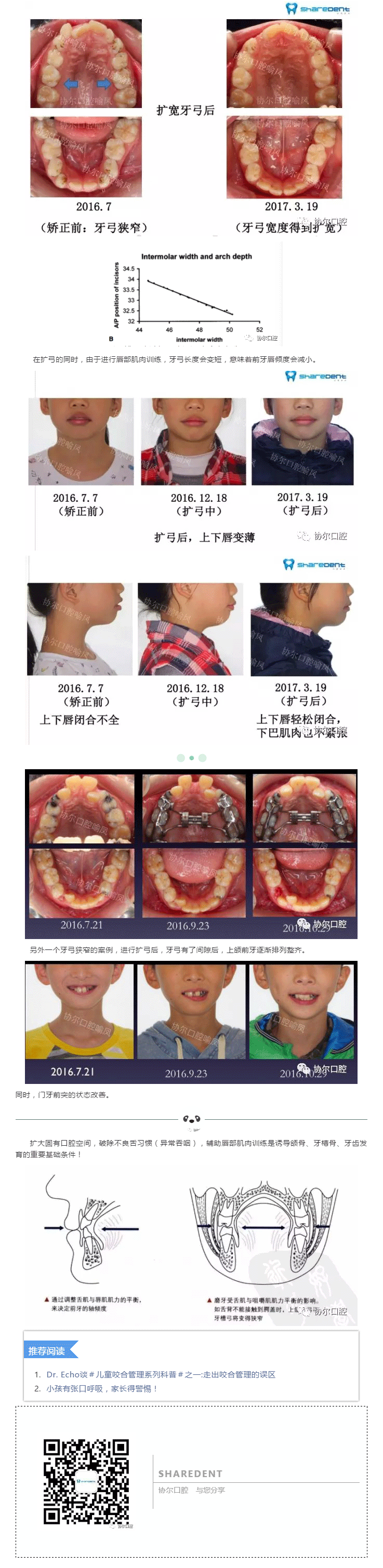 牙弓狭窄,腭部高拱,隐藏的儿童牙颌面部发育异常